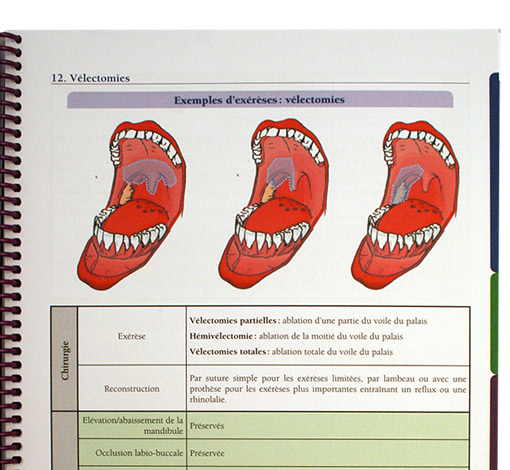 Image de Prise en soin orthophonique du patient dysphagique suite à un cancer bucco-pharyngo-laryngé, produit d'Ortho Édition